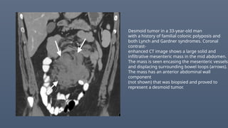 Desmoid tumor in a 33-year-old man
with a history of familial colonic polyposis and
both Lynch and Gardner syndromes. Coronal
contrast-
enhanced CT image shows a large solid and
infiltrative mesenteric mass in the mid abdomen.
The mass is seen encasing the mesenteric vessels
and displacing surrounding bowel loops (arrows).
The mass has an anterior abdominal wall
component
(not shown) that was biopsied and proved to
represent a desmoid tumor.
 