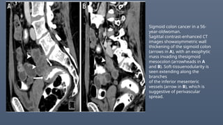 Sigmoid colon cancer in a 56-
year-oldwoman.
Sagittal contrast-enhanced CT
images showasymmetric wall
thickening of the sigmoid colon
(arrows in A), with an exophytic
mass invading thesigmoid
mesocolon (arrowheads in A
and B). Soft-tissuenodularity is
seen extending along the
branches
of the inferior mesenteric
vessels (arrow in B), which is
suggestive of perivascular
spread.
 