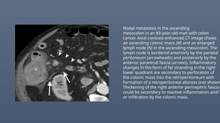Nodal metastasis in the ascending
mesocolon in an 83-year-old man with colon
cancer. Axial contrast-enhanced CT image shows
an ascending colonic mass (M) and an enlarged
lymph node (N) in the ascending mesocolon. The
lymph node is bordered anteriorly by the parietal
peritoneum (arrowheads) and posteriorly by the
anterior pararenal fascia (arrows). Inflammatory
changes in the form of fat stranding in the right
lower quadrant are secondary to perforation of
the colonic mass into the retroperitoneum with
formation of a retroperitoneal abscess (not shown
Thickening of the right anterior perinephric fascia
could be secondary to reactive inflammation and/
or infiltration by the colonic mass.
 