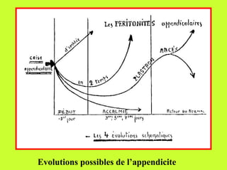 Evolutions possibles de l’appendicite
 