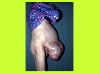 V A H E D I  Lesions