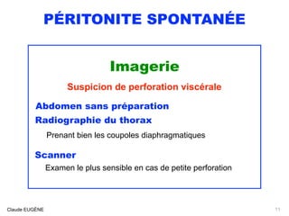 PÉRITONITE SPONTANÉE
Imagerie
Suspicion de perforation viscérale
Abdomen sans préparation
Radiographie du thorax
Prenant bien les coupoles diaphragmatiques
Scanner
Examen le plus sensible en cas de petite perforation
Claude EUGÈNE 11
 