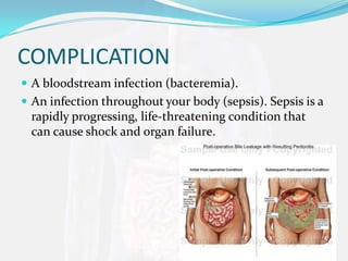 COMPLICATION
 A bloodstream infection (bacteremia).
 An infection throughout your body (sepsis). Sepsis is a
 rapidly progressing, life-threatening condition that
 can cause shock and organ failure.
 