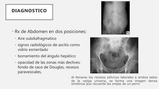 • Rx de Abdomen en dos posiciones:
• Aire subdiafragmatico
• signos radiológicos de ascitis como
vidrio esmerilado
• borramiento del ángulo hepático
• opacidad de las zonas más declives:
fondo de saco de Douglas, recesos
paravesicales,
DIAGNOSTICO
Al llenarse los recesos pélvicos laterales a ambos lados
de la vejiga urinaria, se forma una imagen densa
simétrica que recuerda las orejas de un perro
 