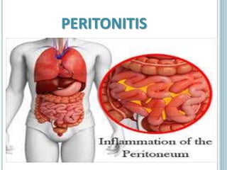 Peritonitis | PPT
