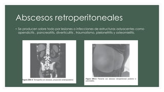 Abscesos retroperitoneales
• Se producen sobre todo por lesiones o infecciones de estructuras adyacentes como
apendicitis , pancreatitis, diverticulitis , traumatismo, pielonefritis y osteomielitis.
 