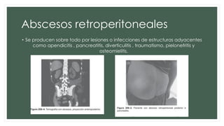 Abscesos retroperitoneales
• Se producen sobre todo por lesiones o infecciones de estructuras adyacentes
como apendicitis , pancreatitis, diverticulitis , traumatismo, pielonefritis y
osteomielitis.
 