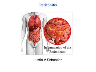 Peritonitis
Justin V Sebastian
 