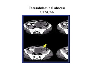 Intraabdominal abscess
CT SCAN
 