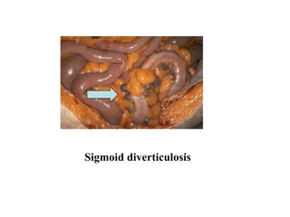 Sigmoid diverticulosis
 