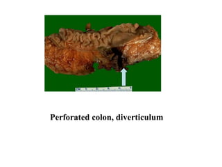 Perforated colon, diverticulum
 