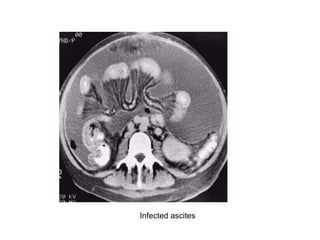 Infected ascites
 