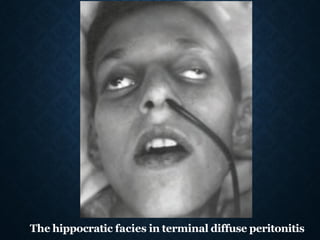 The hippocratic facies in terminal diffuse peritonitis
 