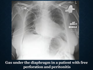 Gas under the diaphragm in a patient with free
perforation and peritonitis
 