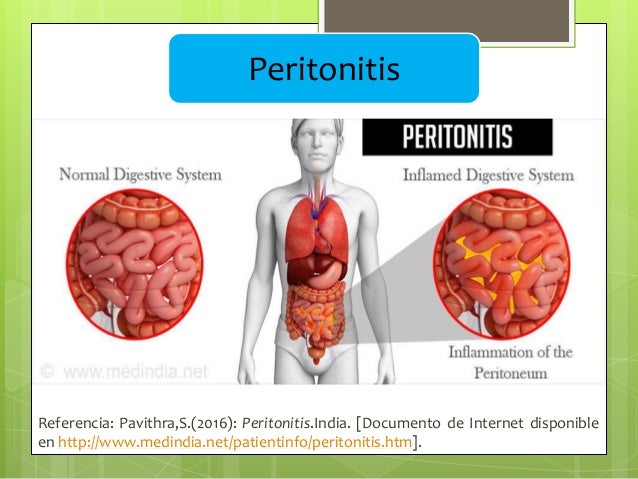 Peritonitis Peritonitis