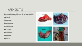 APENDICITIS
Los estadios patológicos de la apendicitis:
Catarral.
Supurada.
Flegmonosa
Gangrenada.
Perforada.
Carcinoide.
Mucocele.
Crónica.
 