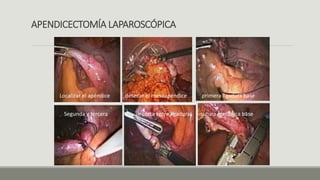 APENDICECTOMÍA LAPAROSCÓPICA
Localizar el apéndice desecar el mesoapéndice primera ligadura base
Segunda y tercera se corta entre ligaduras sutura mecánica base
 