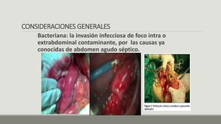 CONSIDERACIONES GENERALES
Bacteriana: la invasión infecciosa de foco intra o
extrabdominal contaminante, por las causas ya
conocidas de abdomen agudo séptico.
 
