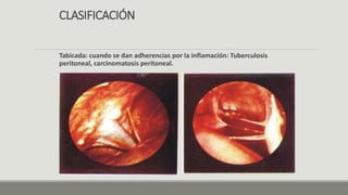 CLASIFICACIÓN
Tabicada: cuando se dan adherencias por la inflamación: Tuberculosis
peritoneal, carcinomatosis peritoneal.
 