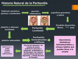 Historia Natural de la Peritonitis
Estímulo mecánico,
químico o bacteriano
reacción
inflamatoria superficie granulosa
y opaca
Exudado (leucocitos,
fibrina pus)Peritonitis
Localizada
plastrón o absceso
localizado
plastrón abscedado
Peritonitis
Generalizadas
o Difusas
hipovolemia,
desbalance
hidroelectrolítico y
choque séptico que
pueden llevar a la
muerte
Pus forma abscesos en
fondos de sacos:
subfrénico derecho o
izquierdo, subhepático o
de Morisson, las coteras
parietocólicas derecha o
izquierda, y fondo de saco
de Douglas
Adherencias y
bridas
Pueden
producir
obstrucciones
 