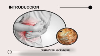 INTRODUCCION
PERITONITIS SECUNDARIA
 