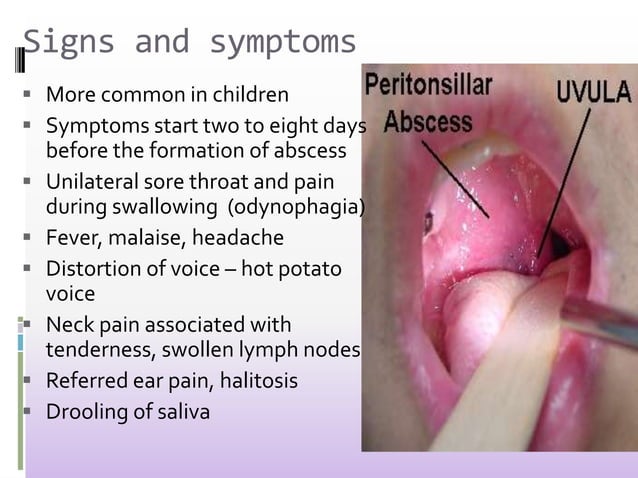 Peritonsilar Abscess a ENT disorder for B.Sc. Nursing students | PPTX ...