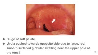 Peritonsillar Abscess quinsy PPTX