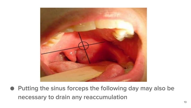 Peritonsillar abscess (quinsy) | PPTX | Ear, Nose and Throat Conditions ...