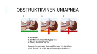 OBSTRUKTIIVINEN UNIAPNEA
A: normaali,
B: osittainen ahtauma/hypopnea
C: täysin tukossa/apnea
Apnean/hypopnean kesto vähintään 10s ja siihen
pitää liittyä 3 % lasku veren happipitoisuudessa.
A B C
 