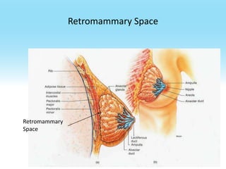 Retromammary Space

Retromammary
Space

 