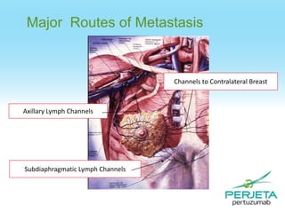 Major Routes of Metastasis

Channels to Contralateral Breast

Axillary Lymph Channels

Subdiaphragmatic Lymph Channels

 