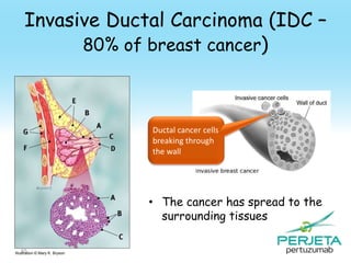 Invasive Ductal Carcinoma (IDC –
80% of breast cancer)

Ductal cancer cells
breaking through
the wall

• The cancer has spread to the
surrounding tissues
65
Illustration © Mary K. Bryson

 