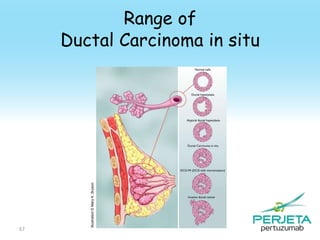 67

Illustration © Mary K. Bryson

Range of
Ductal Carcinoma in situ

 