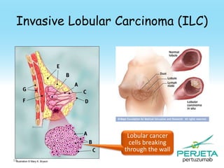 Invasive Lobular Carcinoma (ILC)

Lobular cancer
cells breaking
through the wall
68
Illustration © Mary K. Bryson

 