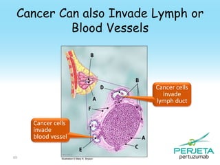 Cancer Can also Invade Lymph or
Blood Vessels

Cancer cells
invade
lymph duct
Cancer cells
invade
blood vessel
69

Illustration © Mary K. Bryson

 