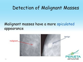 Detection of Malignant Masses
Malignant masses have a more spiculated
appearance
benign
malignant

75

 
