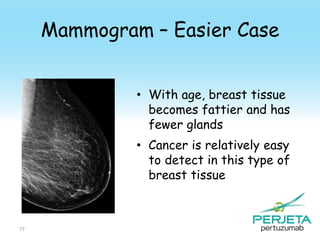 Mammogram – Easier Case
• With age, breast tissue
becomes fattier and has
fewer glands
• Cancer is relatively easy
to detect in this type of
breast tissue

77

 