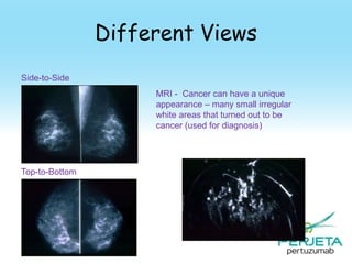 Different Views
Side-to-Side

MRI - Cancer can have a unique
appearance – many small irregular
white areas that turned out to be
cancer (used for diagnosis)

Top-to-Bottom

78

 