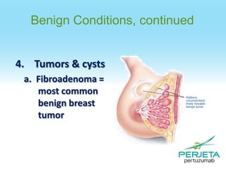 Benign Conditions, continued

4. Tumors & cysts
a. Fibroadenoma =
most common
benign breast
tumor

 