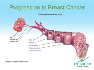 Progression to Breast Cancer

 