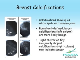 Breast Calcifications
• Calcifications show up as
white spots on a mammogram
• Round well-defined, larger
calcifications (left column)
are more likely benign
• Tight cluster of tiny,
irregularly shaped
calcifications (right column)
may indicate cancer
96

 