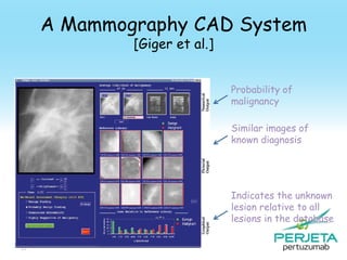 A Mammography CAD System
[Giger et al.]

Probability of
malignancy
Similar images of
known diagnosis

Indicates the unknown
lesion relative to all
lesions in the database
99

 