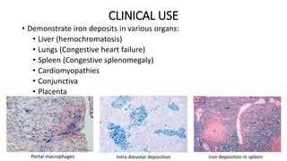 CLINICAL USE
• Demonstrate iron deposits in various organs:
• Liver (hemochromatosis)
• Lungs (Congestive heart failure)
•...