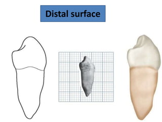 Permanent mandibular first premolar | PPTX