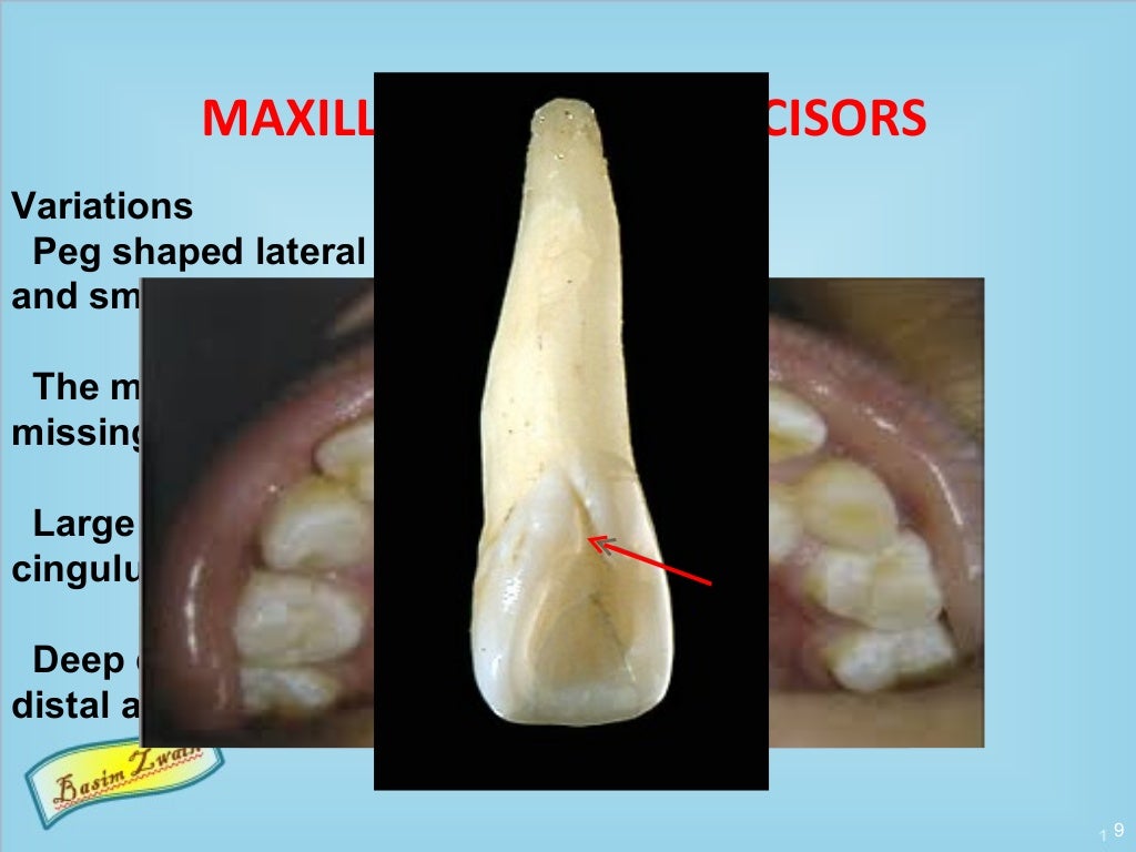 Permanent maxillary lateral incisors