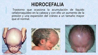 HIDROCEFALIA
Trastorno que ocasiona la acumulación de líquido
cefalorraquídeo en la cabeza y con ello un aumento de la
presión y una expansión del cráneo a un tamaño mayor
que el normal.
 