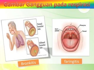 faringitis
 