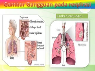 Kanker Paru-paru
 