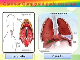 Laringitis   Pleuritis
 