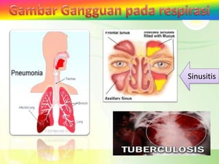 Sinusitis
 